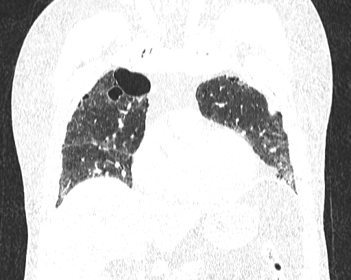 Non-specific interstitial pneumonia (NSIP) (Radiopaedia 68599-78228 Coronal lung window 27).jpg