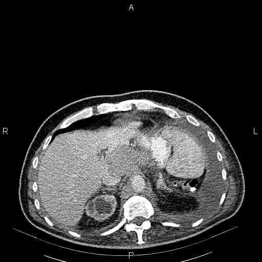 File:Non Hodgkin lymphoma in a patient with ankylosing spondylitis (Radiopaedia 84323-99621 B 30).jpg