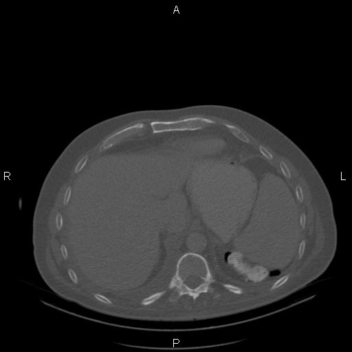 Non Hodgkin lymphoma in a patient with ankylosing spondylitis (Radiopaedia 84323-99624 Axial bone window 26).jpg