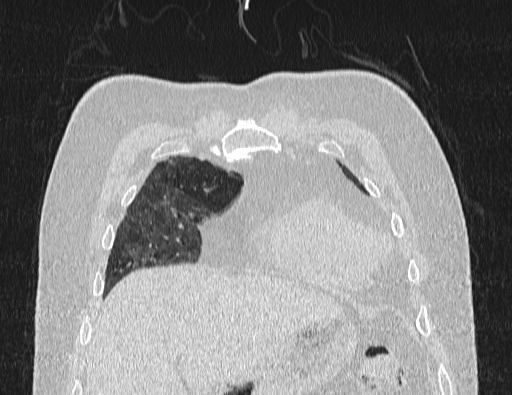 Non specific interstitial pneumonia (NSIP) (Radiopaedia 89725-106798 Coronal lung window 16).jpg