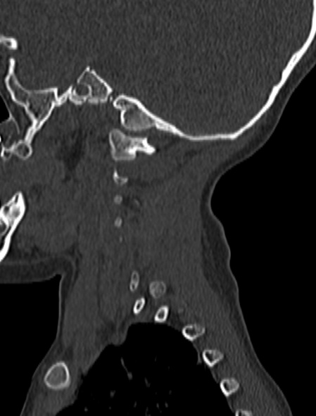 Normal CT cervical spine - pediatric (Radiopaedia 52549-58462 Sagittal bone window 191).jpg