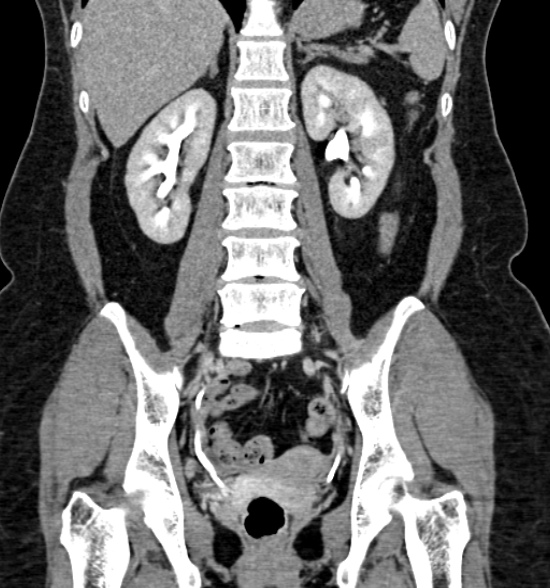 Normal CT intravenous urogram (Radiopaedia 39444-41759 A 301).jpg