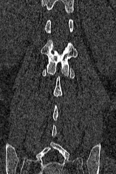 Normal CT lumbar spine (Radiopaedia 53981-60118 Coronal bone window 52).jpg
