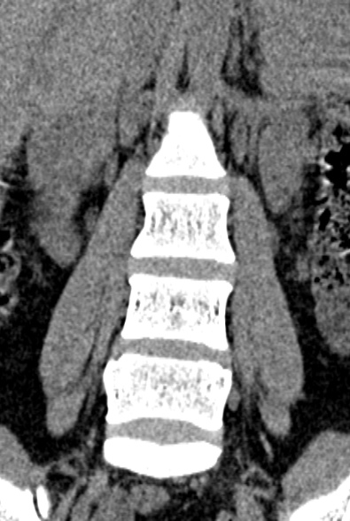 Normal CT lumbar spine (Radiopaedia 53981-60118 F 26).jpg