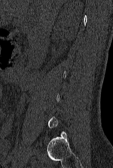 File:Normal CT lumbar spine (Radiopaedia 53981-60118 Sagittal bone window 11).jpg