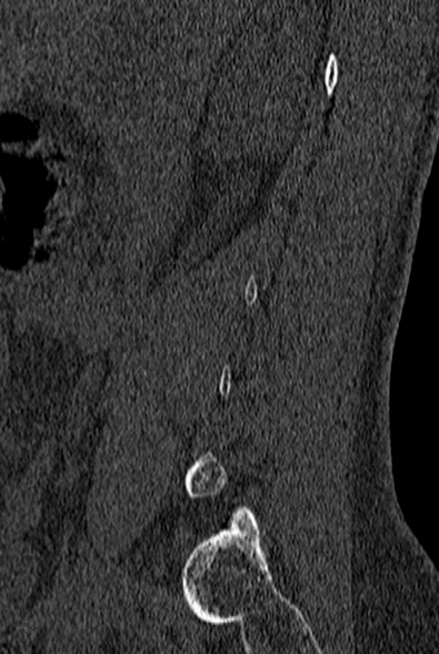 File:Normal CT lumbar spine (Radiopaedia 53981-60118 Sagittal bone window 12).jpg