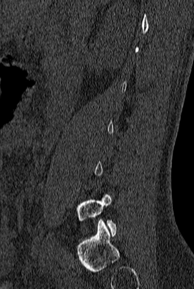 File:Normal CT lumbar spine (Radiopaedia 53981-60118 Sagittal bone window 17).jpg