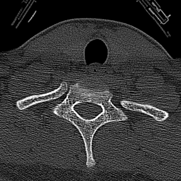 Normal CT of the cervical spine (Radiopaedia 53322-59305 Axial bone window 228).jpg