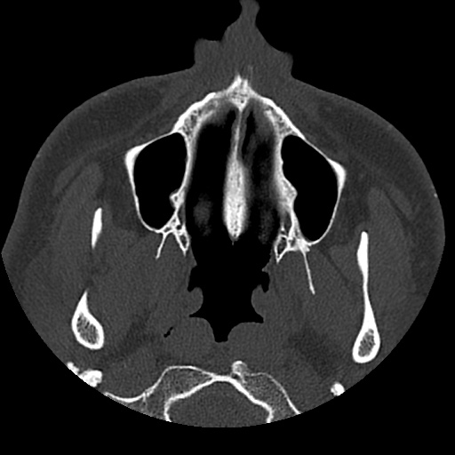 Normal CT paranasal sinuses (Radiopaedia 42286-45390 Axial bone window 90).jpg