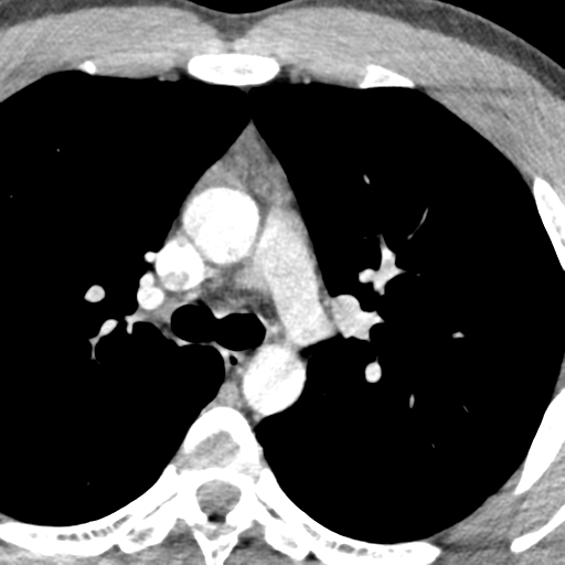 File:Normal CT pulmonary veins (pre RF ablation) (Radiopaedia 41748-44702 A 44).png