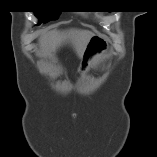 File:Normal CT renal artery angiogram (Radiopaedia 38727-40889 B 10).png