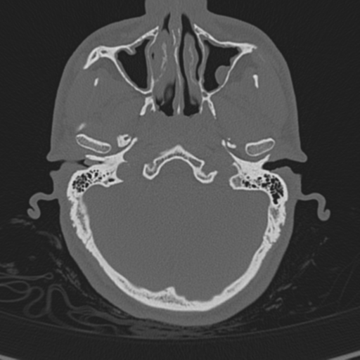 Normal CT skull (Radiopaedia 40798-43459 A 31).png
