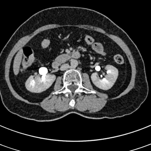 File:Normal CT split bolus study of the renal tract (Radiopaedia 48631-53634 Axial split bolus 93).jpg