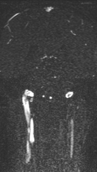 Normal MRI brain with MRV- teenager (Radiopaedia 49425-54553 Coronal MRV 153).jpg