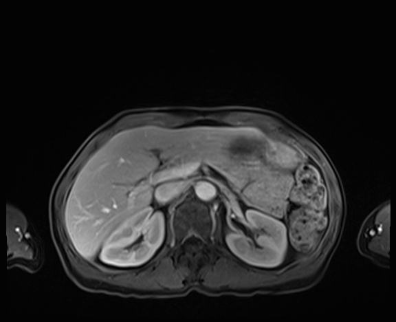 Normal adrenal glands MRI (Radiopaedia 82017-96004 K 31).jpg