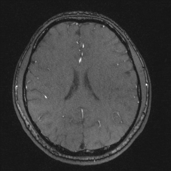 Normal brain MRI including MRA (Radiopaedia 48748-53763 Axial MRA 139).jpg