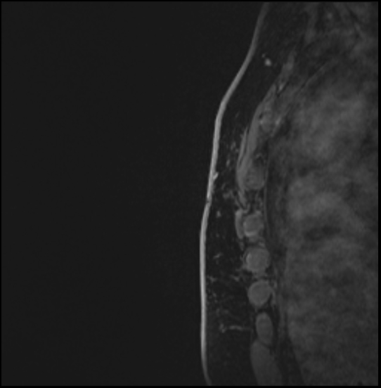 Normal breast MRI - dense breasts (Radiopaedia 80454-93850 I 175).jpg