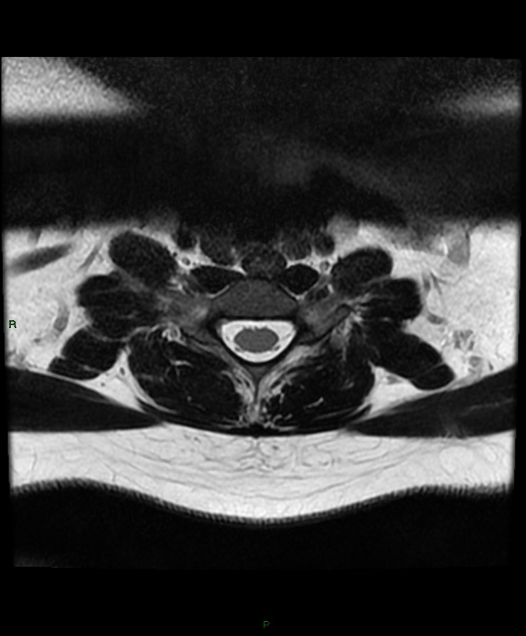 Normal cervical spine MRI (Radiopaedia 80146-93454 Axial T2 78).jpg