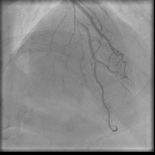 Normal coronary angiogram (DSA) (Radiopaedia 63081-71571 E 69).jpg