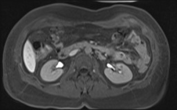 File:Normal hepatobiliary phase liver MRI (Radiopaedia 58968-66230 A 65).jpg