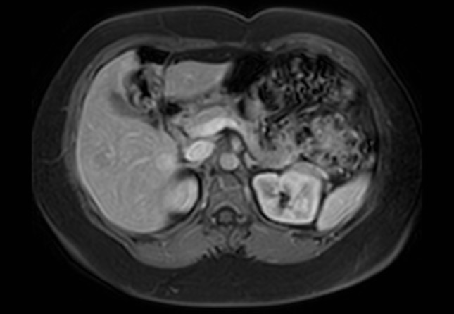 Normal liver MRI with Gadolinium (Radiopaedia 58913-66163 J 38).jpg