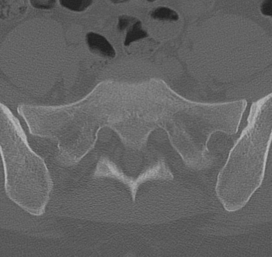 File:Normal lumbar spine CT (Radiopaedia 46533-50986 Axial bone window 69).png
