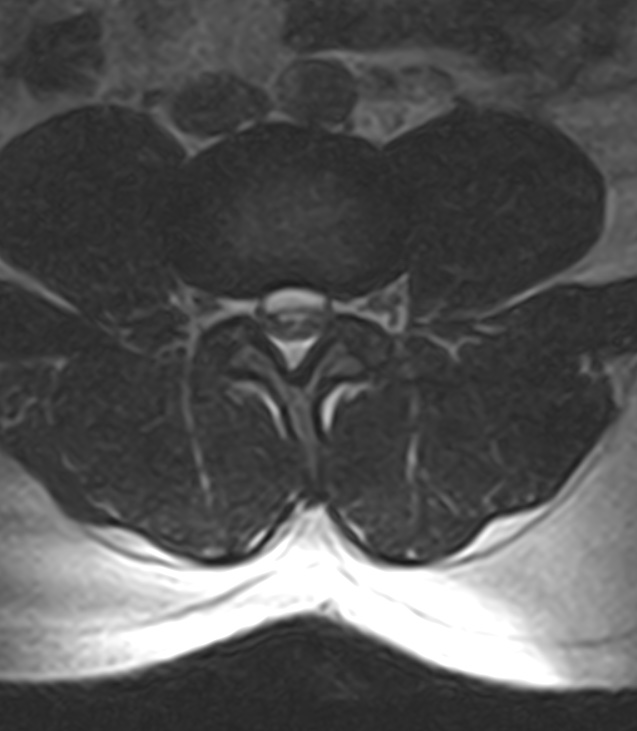 Normal lumbar spine MRI - low-field MRI scanner (Radiopaedia 40976-43699 Axial T2 61).jpg
