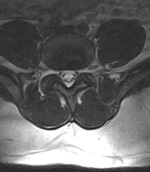 Normal lumbar spine MRI - low-field MRI scanner (Radiopaedia 40976-43699 Axial T2 74).jpg