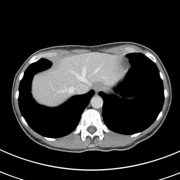 File:Normal multiphase CT liver (Radiopaedia 38026-39996 C 7).jpg