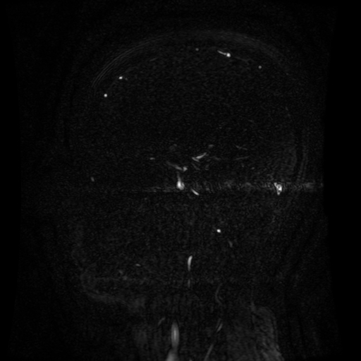 Normal noncontrast MR venography (Radiopaedia 87578-103957 A 65).jpg