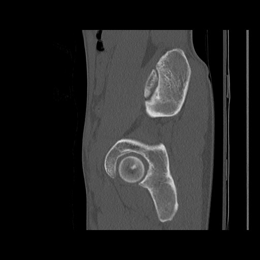 Normal pelvis (Radiopaedia 51473-57238 Sagittal bone window 106).jpg