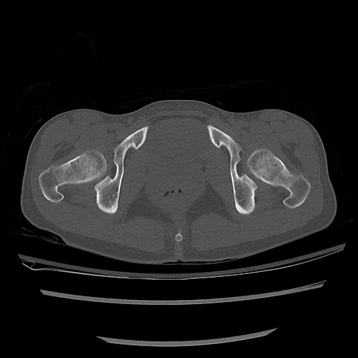 Normal pelvis CT (Radiopaedia 51471-57236 Axial bone window 80).jpg