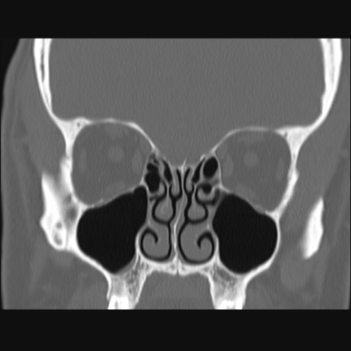 Normal sinus CT (annotated) (Radiopaedia 78917-91810 Coronal bone window 28).jpg