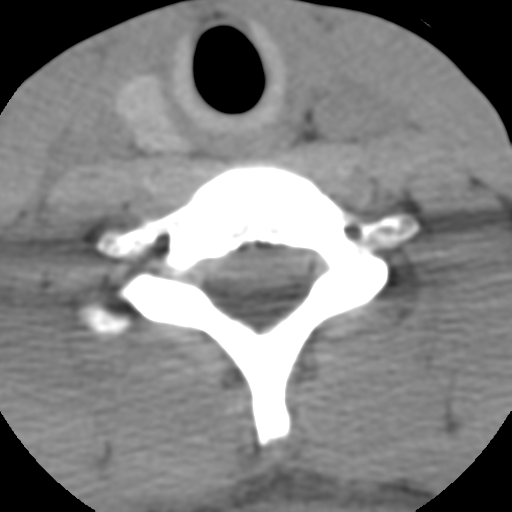 Normal trauma cervical spine (Radiopaedia 41017-43760 Axial non-contrast 46).png