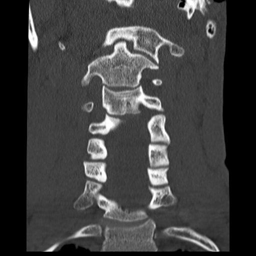 File:Normal trauma cervical spine (Radiopaedia 41017-43760 Coronal bone window 16).png