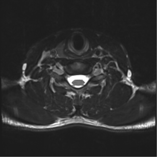 Normal trauma cervical spine (Radiopaedia 41017-43762 D 40).png