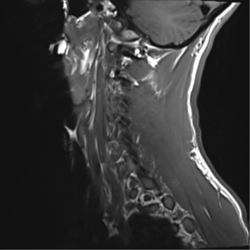 File:Normal trauma cervical spine (Radiopaedia 41017-43762 Sagittal T1 1).png