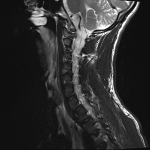 File:Normal trauma cervical spine (Radiopaedia 41017-43762 Sagittal T2 5).png