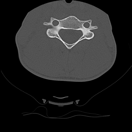 Normal trauma spine imaging (age 16) (Radiopaedia 45335-49358 Axial bone window 46).jpg
