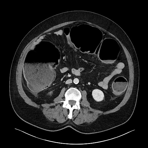 Obstructing sigmoid adenocarcinoma (Radiopaedia 58465-65619 A 84).jpg