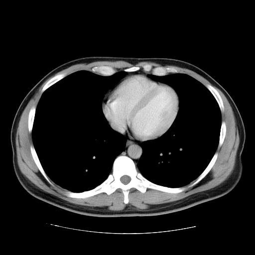 File:Obstructing ureteric calculus (Radiopaedia 18615-18514 B 3).jpg