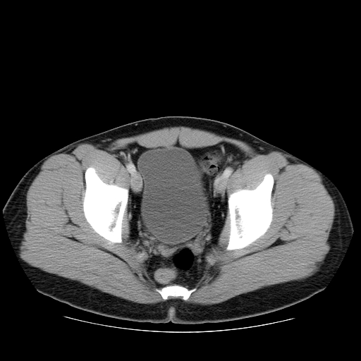 File:Obstructing ureteric calculus (Radiopaedia 18615-18514 B 50).jpg