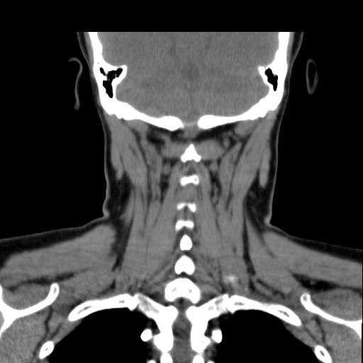 File:Obstructive sleep apnea (CT evaluation) (Radiopaedia 24304-24582 Coronal non-contrast 78).jpg