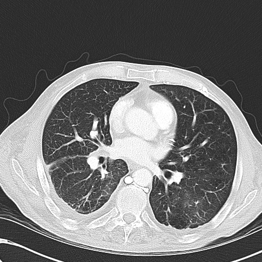 File:Obstructive superior vena cava tumor thrombus (Radiopaedia 28046-28306 Axial lung window 30).jpg