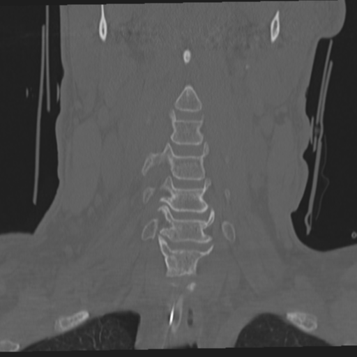 File:Occipital condyle fracture (Radiopaedia 33467-34517 Coronal bone window 21).png