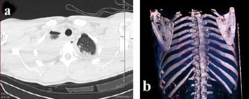 a)Axial computed tomography showing- bilateral scapular fractures (bilateral pulmonary contusion, left haemothorax) b) 3D computed tomography reconstruction shows bilateral scapular body fractures