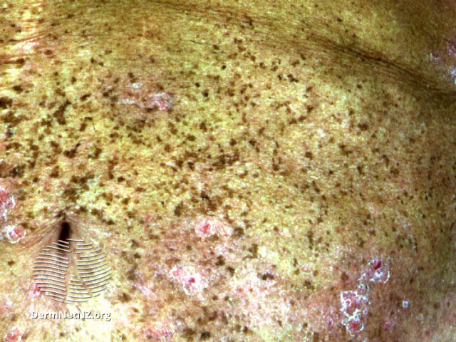 File:See more images of lentigines... (DermNet NZ lesions-lentigo7).jpg