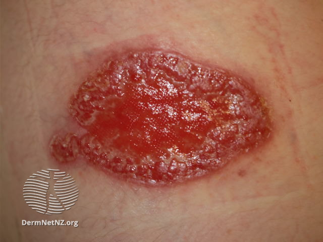 File:Ulcer (DermNet NZ arthropods-leishmaniasis9).jpg