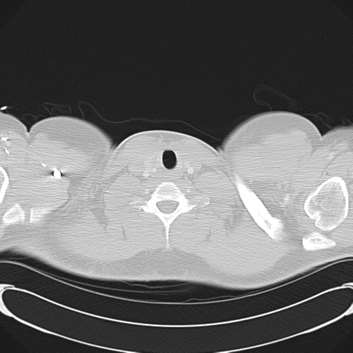 File:'Bovine' aortic arch (Radiopaedia 33554-34637 Axial lung window 1).png