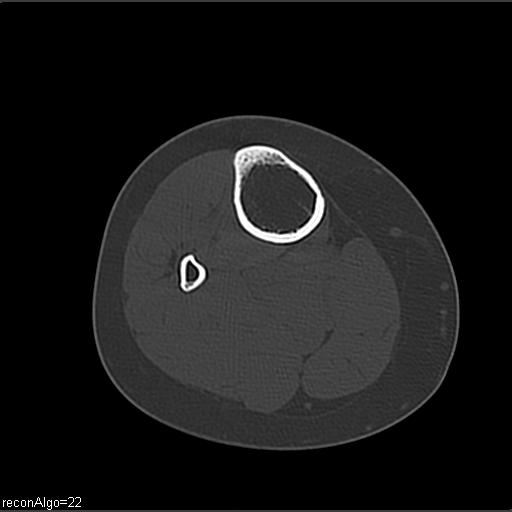 File:ACL avulsion fracture (Radiopaedia 33833-34994 Axial bone window 29).jpg